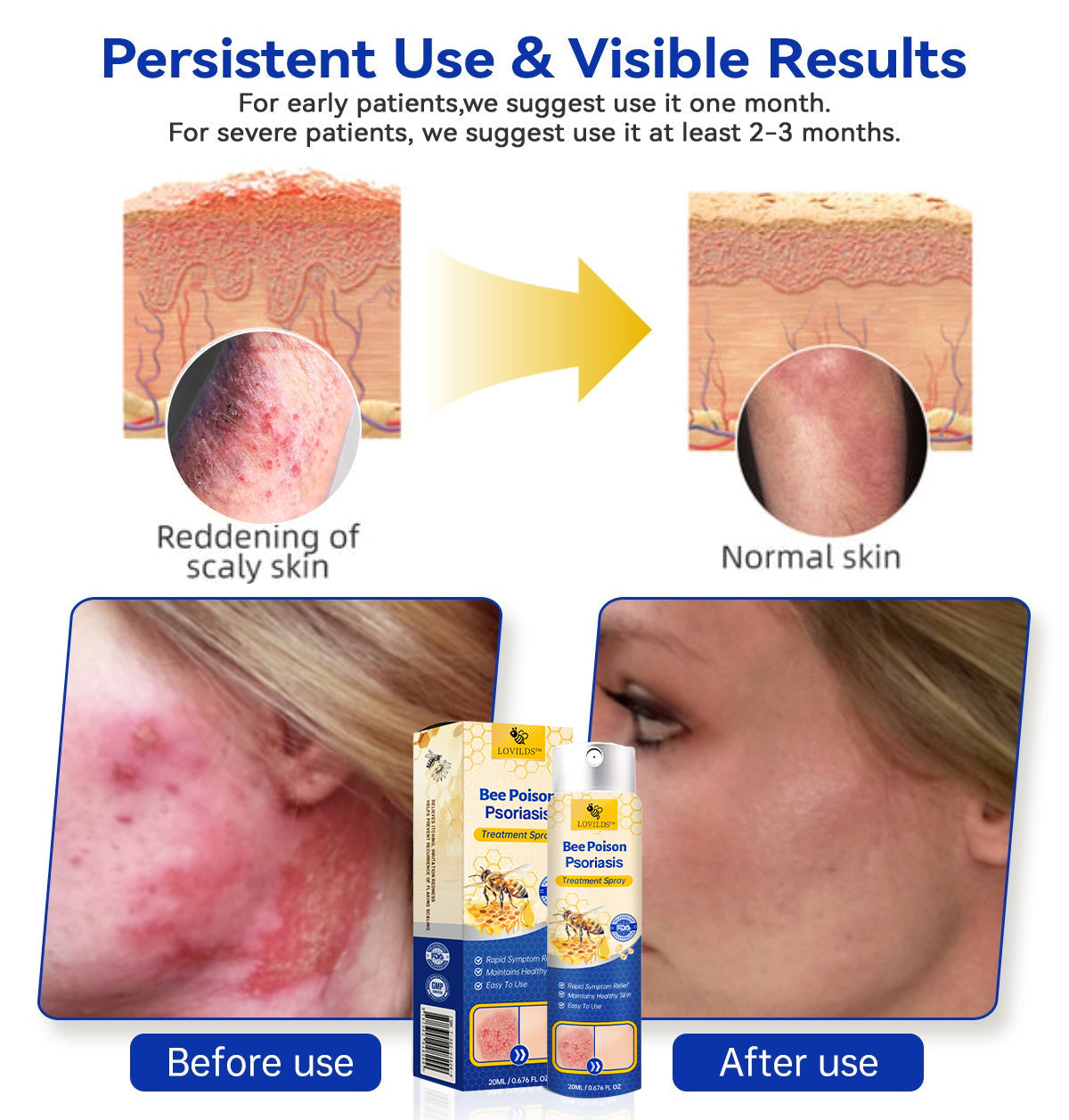 ❤️LOVILDS™ PsoriaHeal Bee poison Psoriasis Treatment Spray pro (Suitable for all skin conditions)