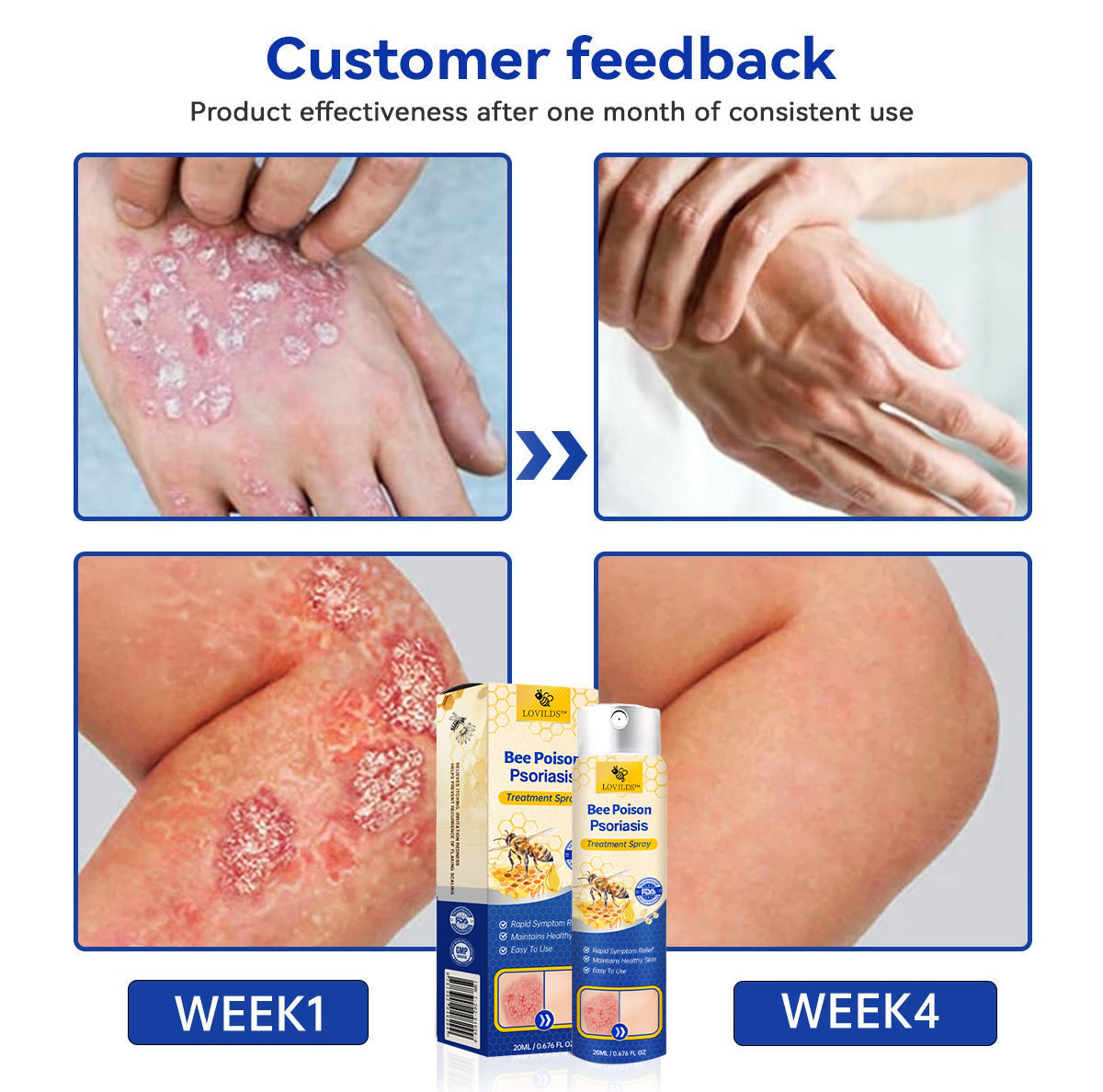 ❤️LOVILDS™ PsoriaHeal Bee poison Psoriasis Treatment Spray pro (Suitable for all skin conditions)