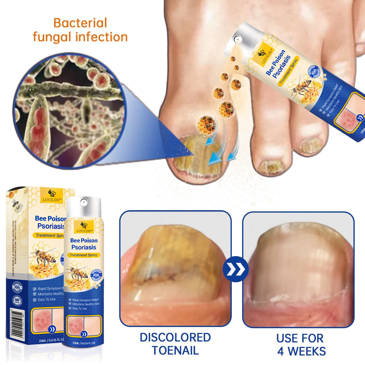 ❤️LOVILDS™ PsoriaHeal Bee poison Psoriasis Treatment Spray pro (Suitable for all skin conditions)