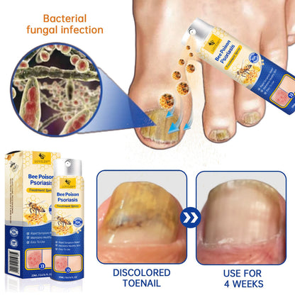 ❤️LOVILDS™ PsoriaHeal Bee poison Psoriasis Treatment Spray pro (Suitable for all skin conditions)