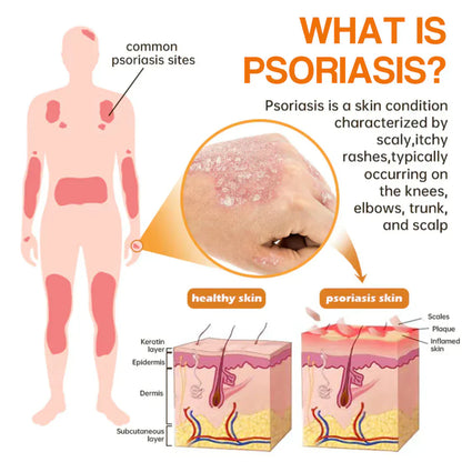 ❤️LOVILDS™ PsoriaHeal Bee poison Psoriasis Treatment Spray pro (Suitable for all skin conditions)