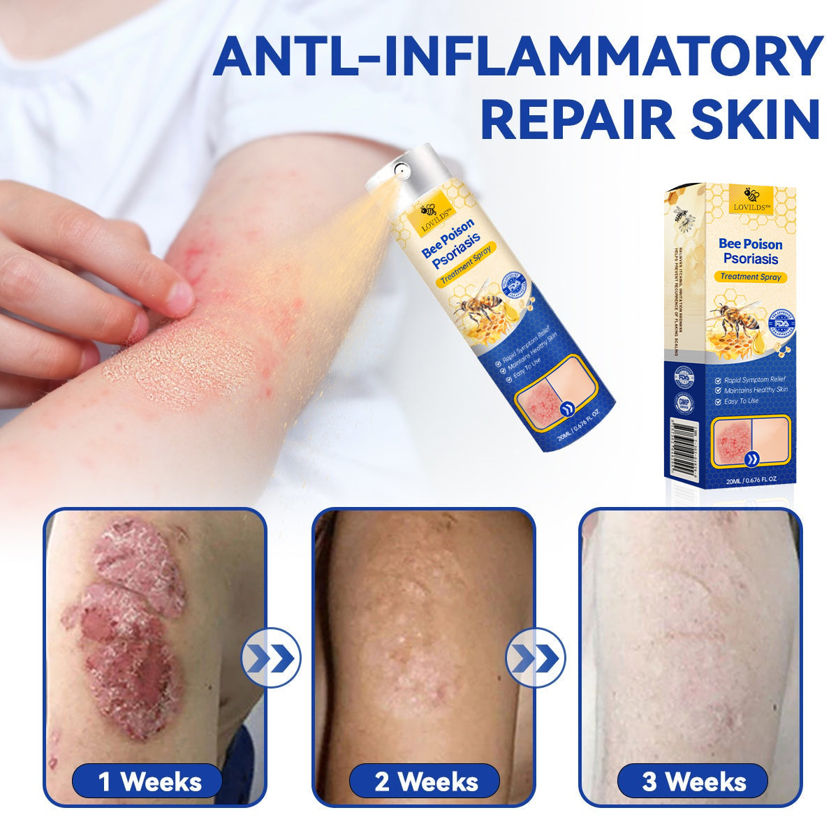 ❤️LOVILDS™ PsoriaHeal Bee poison Psoriasis Treatment Spray pro (Suitable for all skin conditions)