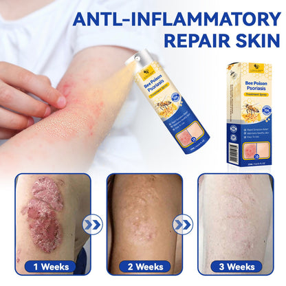 ❤️LOVILDS™ PsoriaHeal Bee poison Psoriasis Treatment Spray pro (Suitable for all skin conditions)